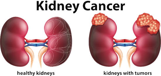 Nierenkrebs
