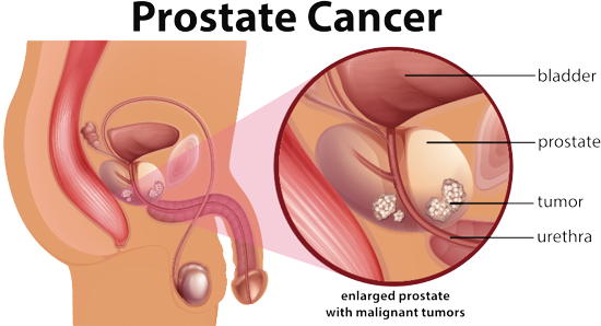 Prostatakrebs