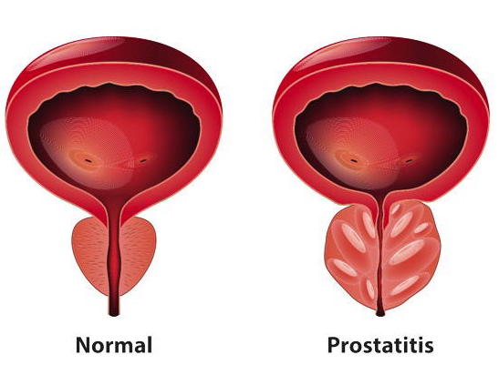 Prostataentzündung